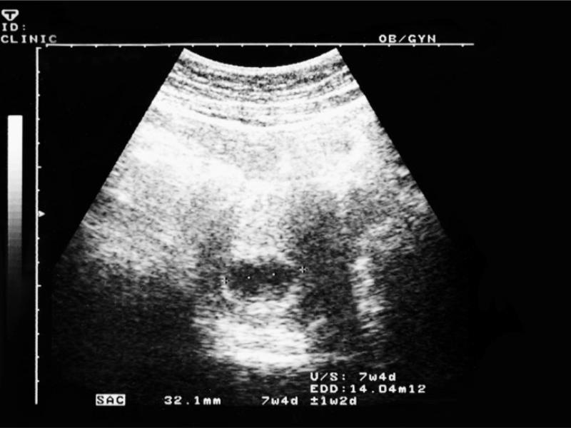 ULTRASOUNDS AND ABORTION IN FLORIDA